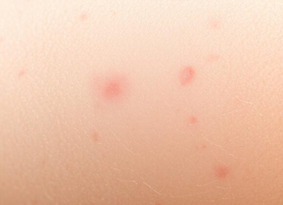 Terapia blizn potrądzikowych: Jak kwasy mogą pomóc w leczeniu? image-1742825328.jpg